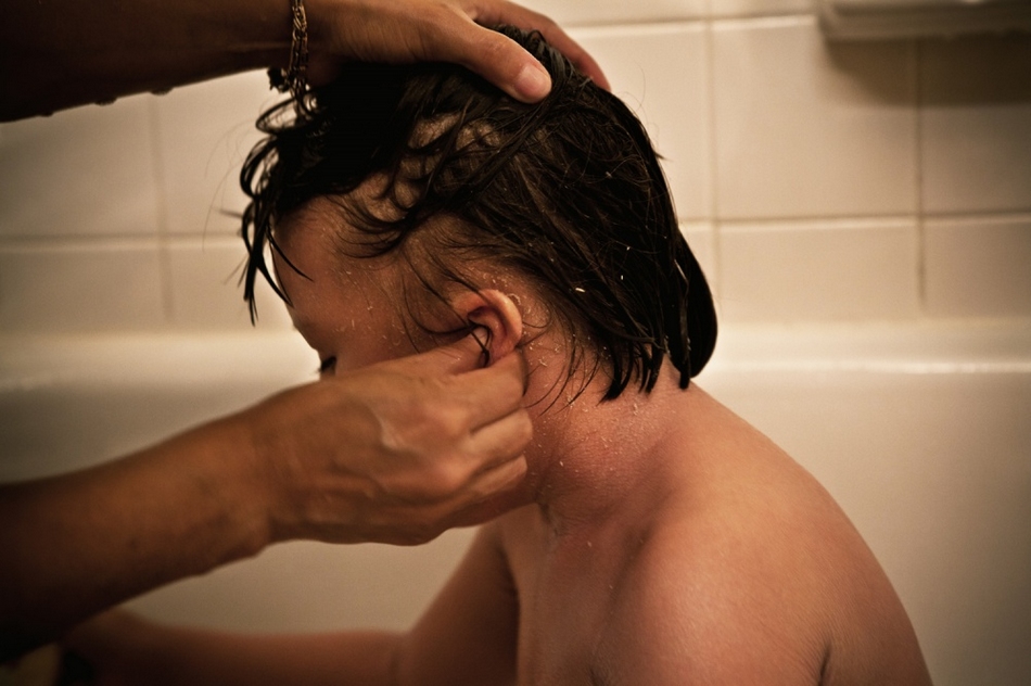 孤兒?。呼~鱗病女孩的艱難生活【圖】