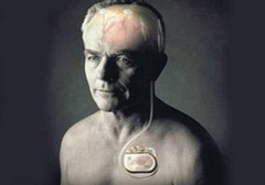 起搏器真的能治好帕金森病嗎？