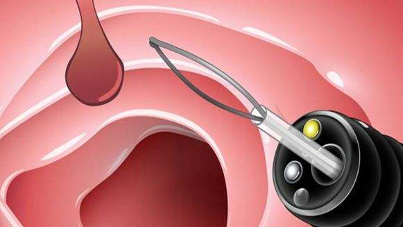 【健康解碼&middot;小貼士】檢查出息肉 需要切除嗎？