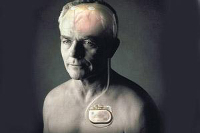 【健康解碼】起搏器真的能治好帕金森病嗎？